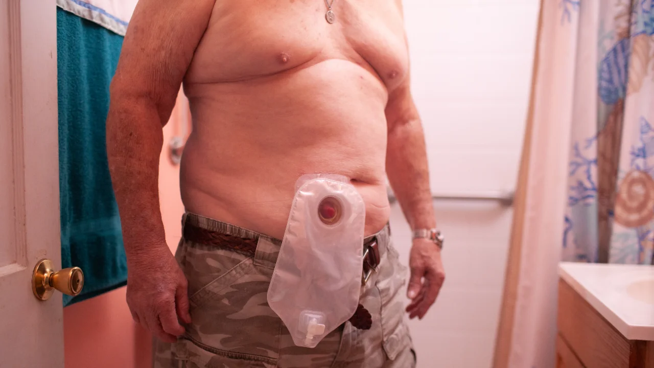 Ein Bild einer Person, die einen Stomabeutel trägt.